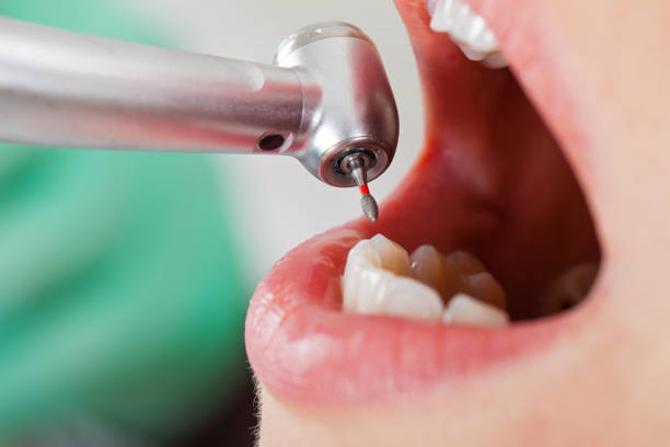 Best Emergency Dental Extractions in Neenah, WI